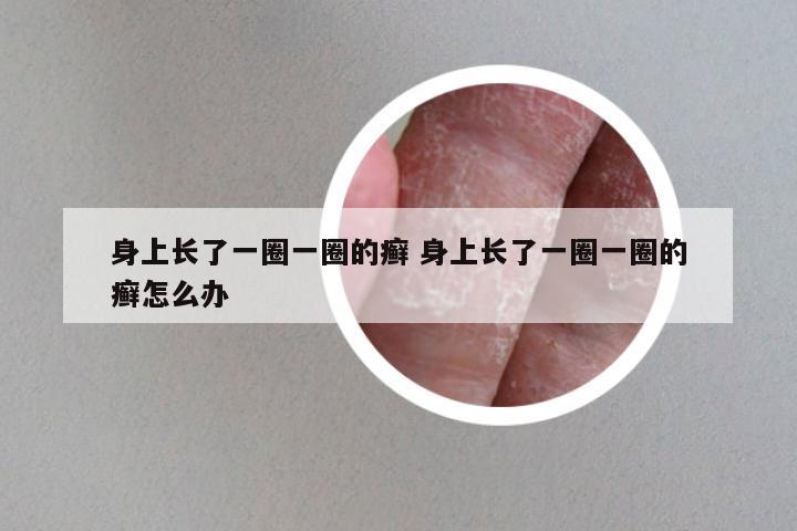 身上长了一圈一圈的癣 身上长了一圈一圈的癣怎么办