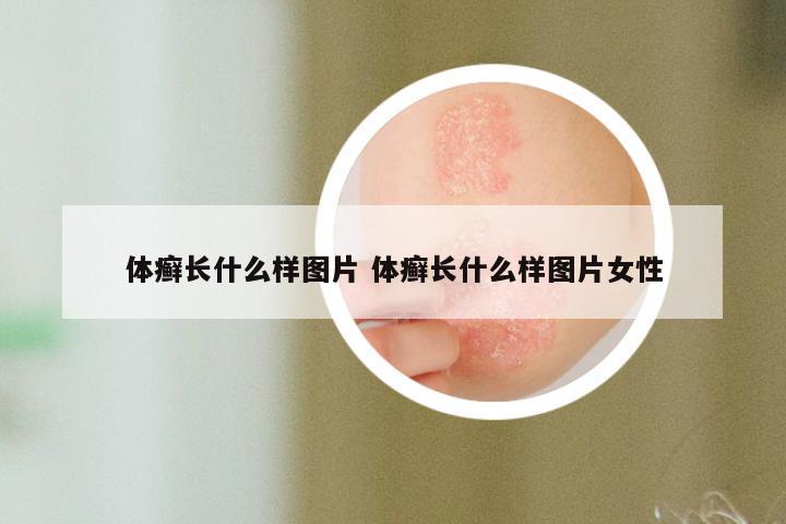 体癣长什么样图片 体癣长什么样图片女性