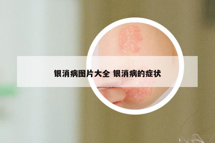 银消病图片大全 银消病的症状