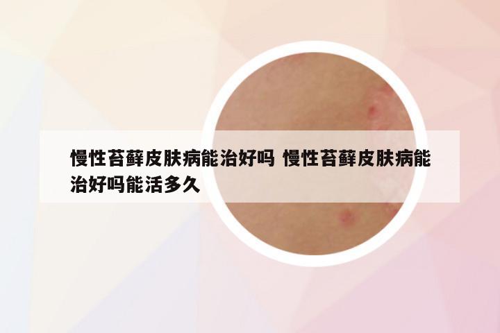慢性苔藓皮肤病能治好吗 慢性苔藓皮肤病能治好吗能活多久