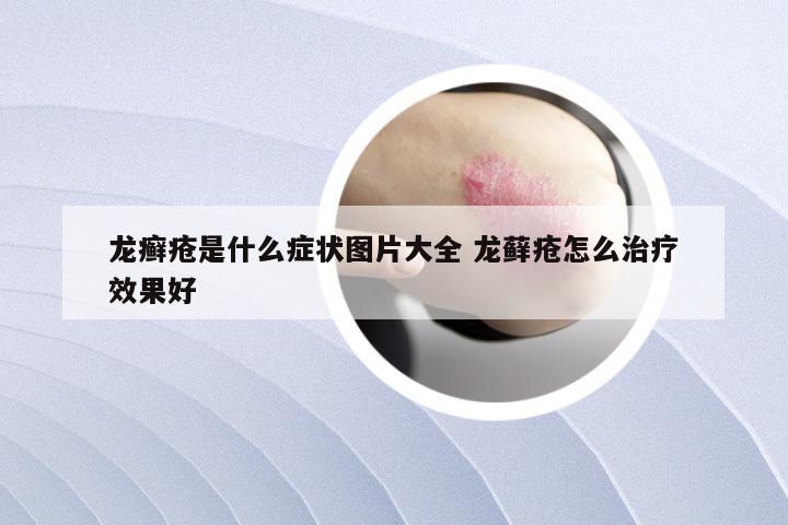龙癣疮是什么症状图片大全 龙藓疮怎么治疗效果好