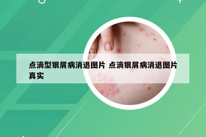 点滴型银屑病消退图片 点滴银屑病消退图片真实