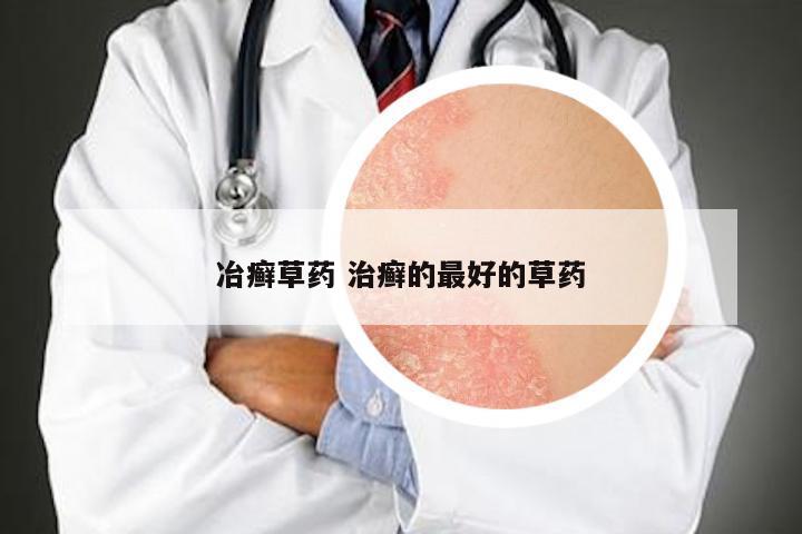 冶癣草药 治癣的最好的草药