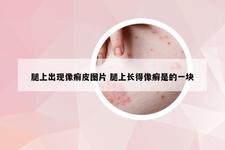 腿上出现像癣皮图片 腿上长得像癣是的一块