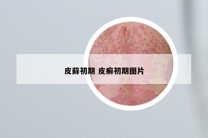 皮藓初期 皮癣初期图片