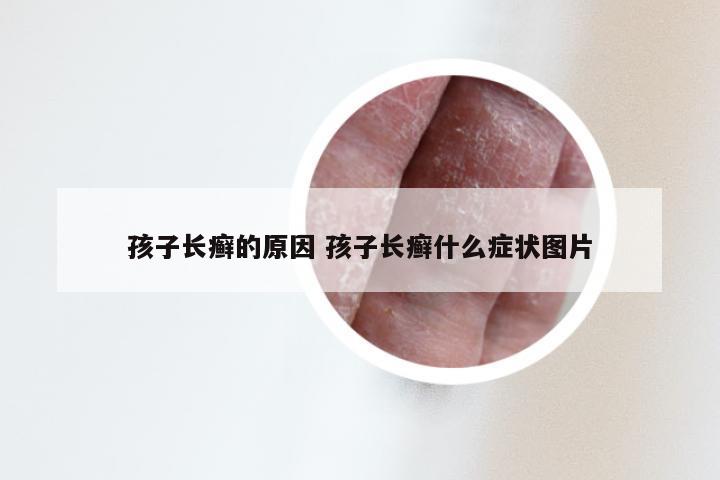 孩子长癣的原因 孩子长癣什么症状图片
