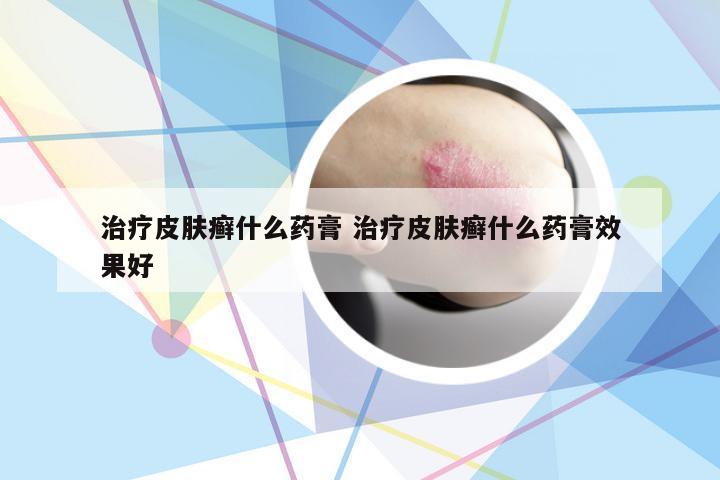 治疗皮肤癣什么药膏 治疗皮肤癣什么药膏效果好