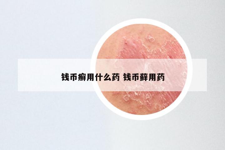 钱币癣用什么药 钱币藓用药