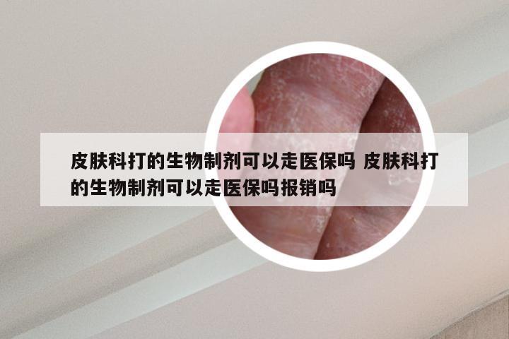皮肤科打的生物制剂可以走医保吗 皮肤科打的生物制剂可以走医保吗报销吗