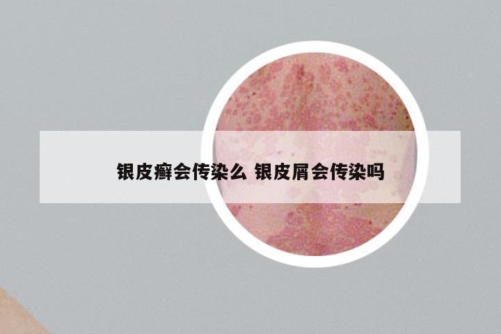 银皮癣会传染么 银皮屑会传染吗