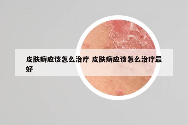 皮肤癣应该怎么治疗 皮肤癣应该怎么治疗最好