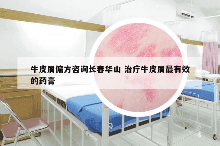 牛皮屑偏方咨询长春华山 治疗牛皮屑最有效的药膏