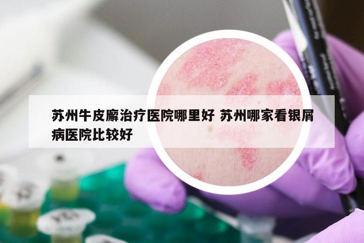 苏州牛皮廨治疗医院哪里好 苏州哪家看银屑病医院比较好
