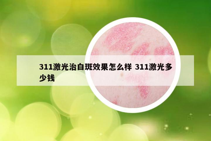 311激光治白斑效果怎么样 311激光多少钱