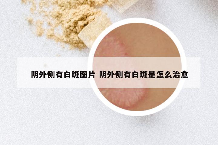 阴外侧有白斑图片 阴外侧有白斑是怎么治愈
