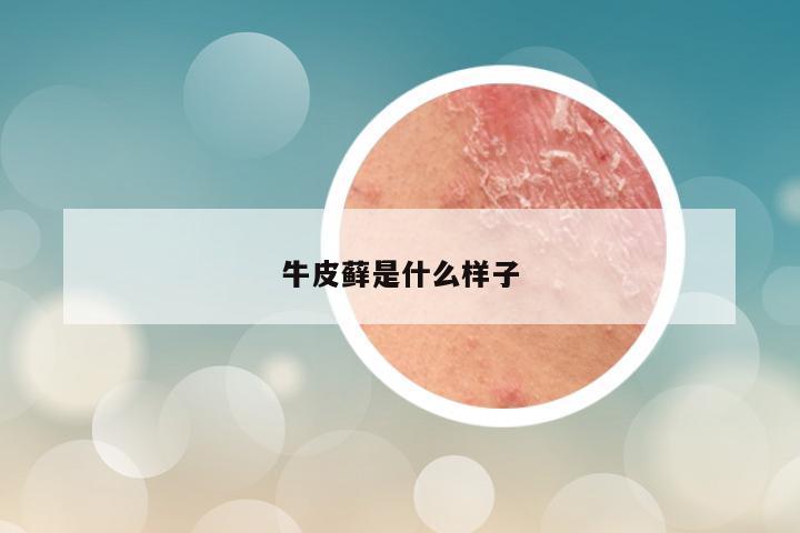 牛皮藓是什么样子