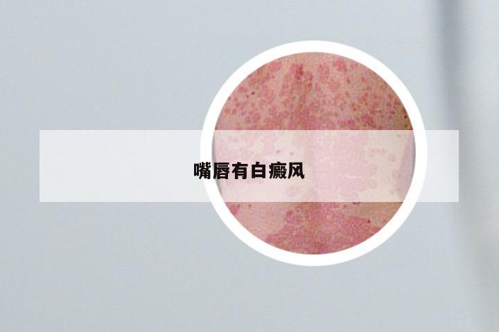 嘴唇有白癜风