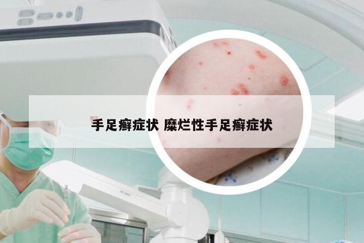 手足癣症状 糜烂性手足癣症状