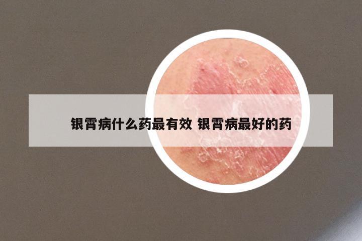 银霄病什么药最有效 银霄病最好的药