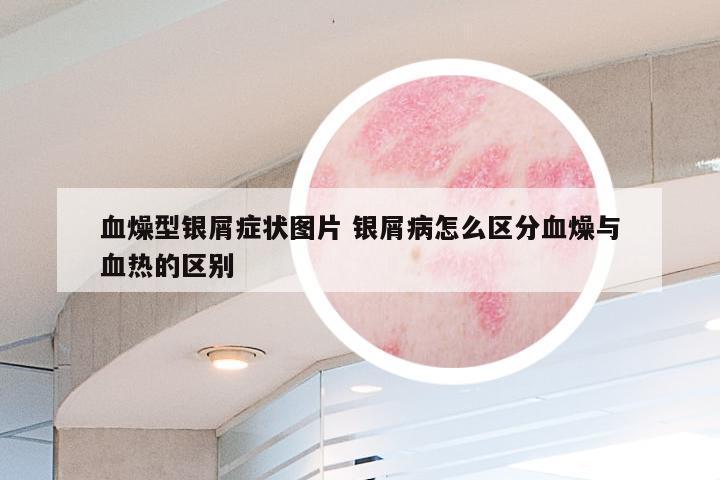 血燥型银屑症状图片 银屑病怎么区分血燥与血热的区别