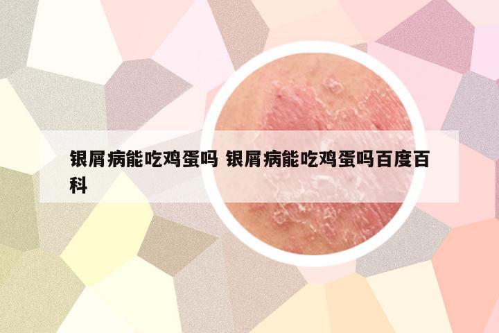 银屑病能吃鸡蛋吗 银屑病能吃鸡蛋吗百度百科