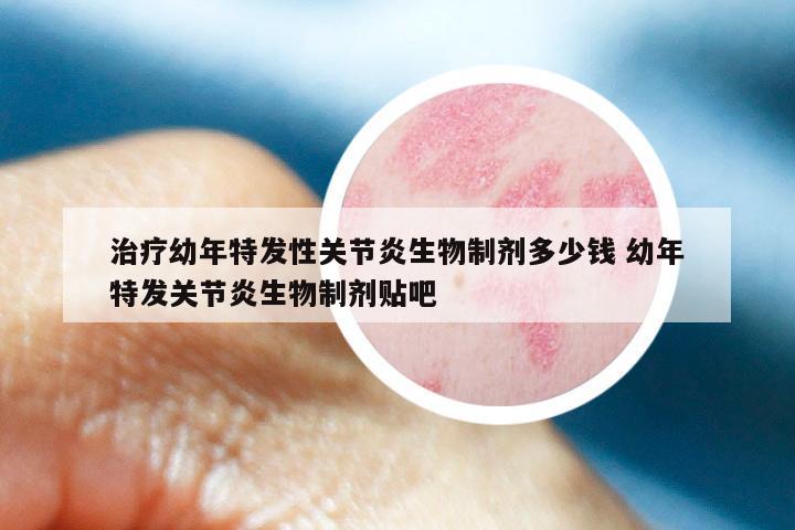 治疗幼年特发性关节炎生物制剂多少钱 幼年特发关节炎生物制剂贴吧