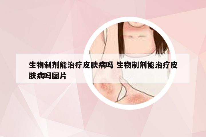 生物制剂能治疗皮肤病吗 生物制剂能治疗皮肤病吗图片