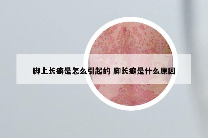 脚上长癣是怎么引起的 脚长癣是什么原因