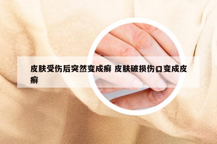 皮肤受伤后突然变成癣 皮肤破损伤口变成皮癣
