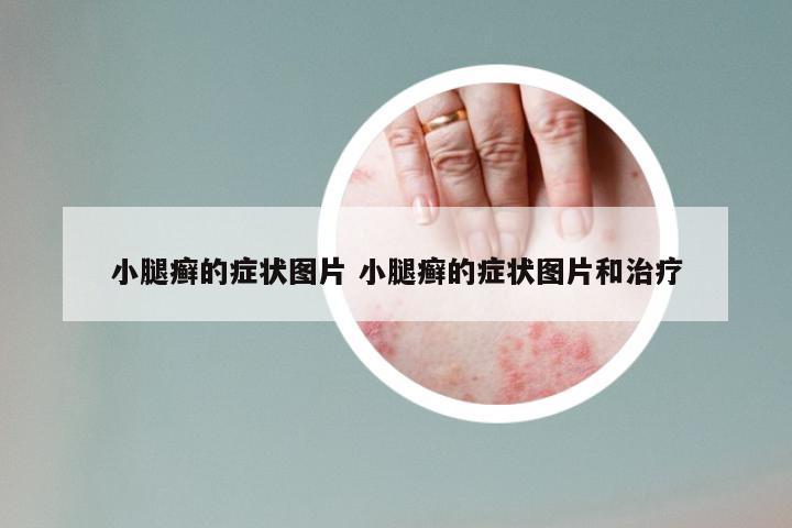 小腿癣的症状图片 小腿癣的症状图片和治疗