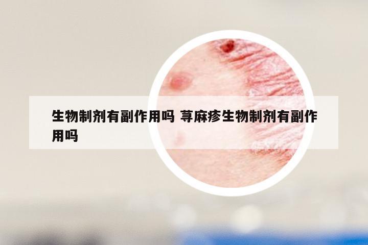 生物制剂有副作用吗 荨麻疹生物制剂有副作用吗