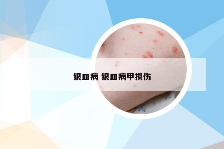 银皿病 银皿病甲损伤