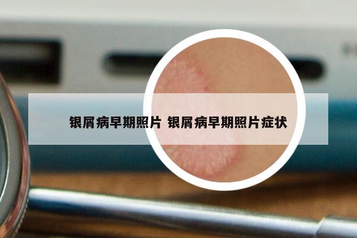 银屑病早期照片 银屑病早期照片症状