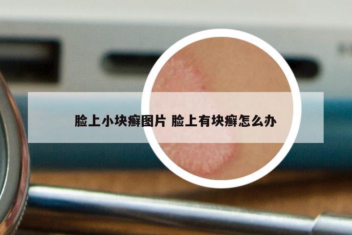 脸上小块癣图片 脸上有块癣怎么办