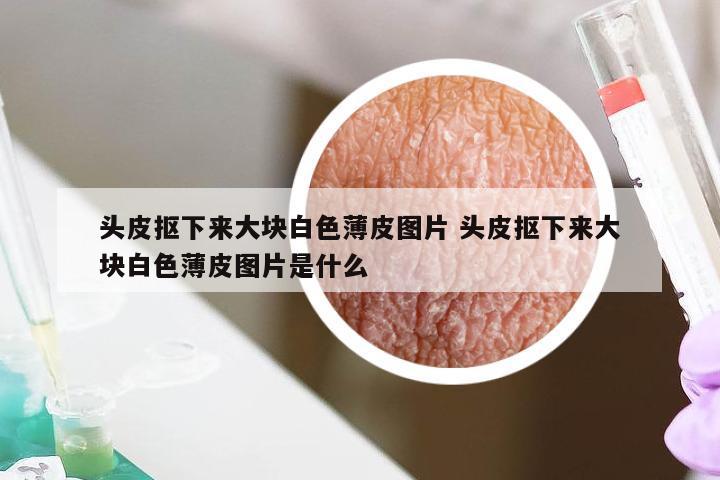 头皮抠下来大块白色薄皮图片 头皮抠下来大块白色薄皮图片是什么