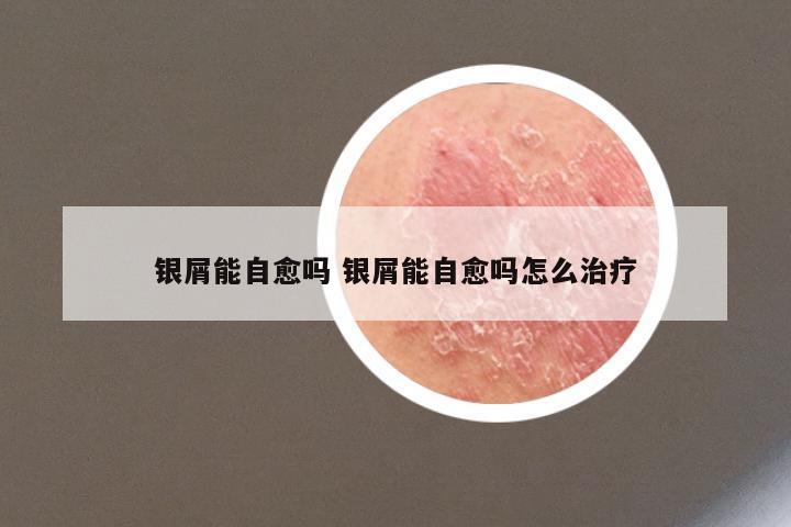 银屑能自愈吗 银屑能自愈吗怎么治疗
