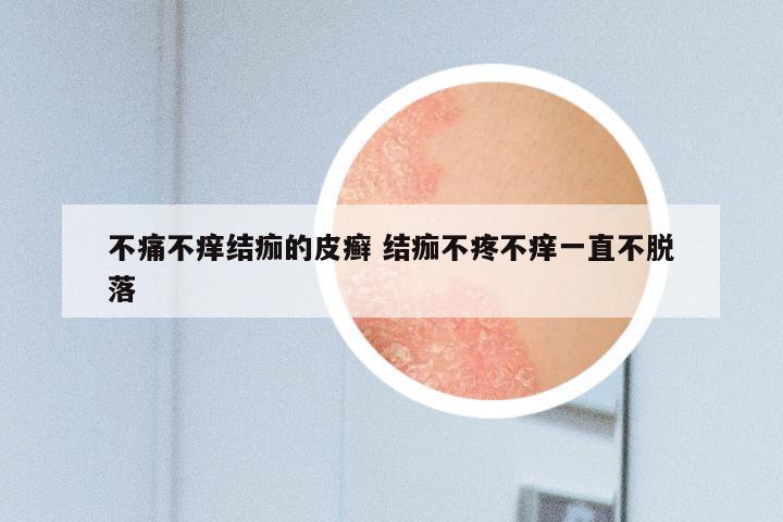 不痛不痒结痂的皮癣 结痂不疼不痒一直不脱落