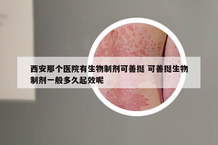 西安那个医院有生物制剂可善挺 可善挺生物制剂一般多久起效呢