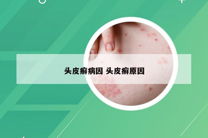 头皮癣病因 头皮癣原因