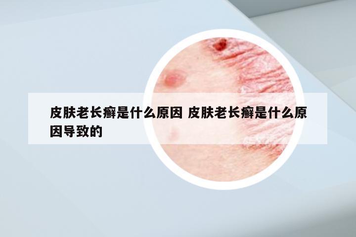 皮肤老长癣是什么原因 皮肤老长癣是什么原因导致的