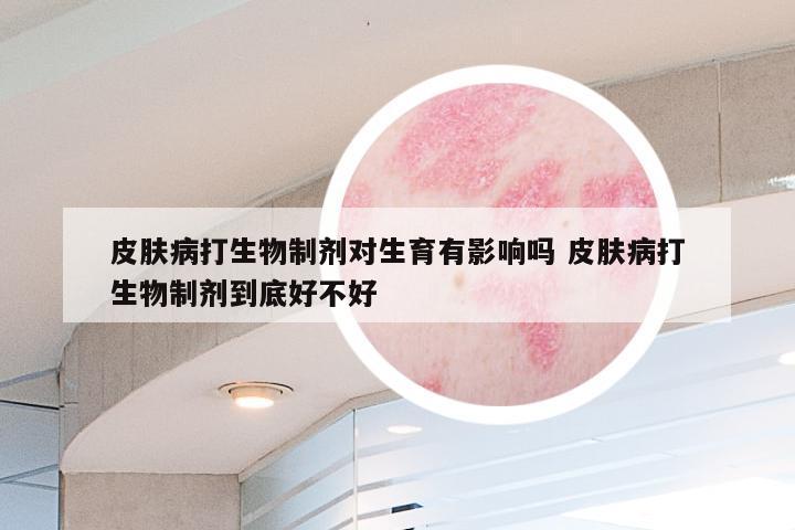 皮肤病打生物制剂对生育有影响吗 皮肤病打生物制剂到底好不好