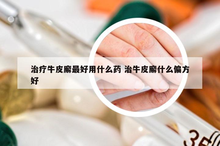 治疗牛皮廨最好用什么药 治牛皮廨什么偏方好