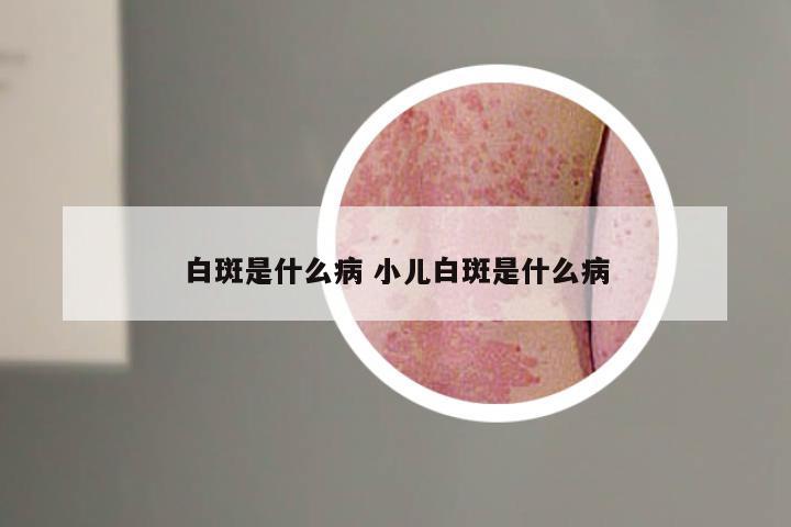 白斑是什么病 小儿白斑是什么病