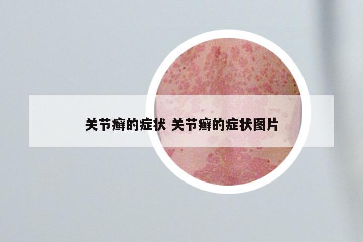 关节癣的症状 关节癣的症状图片