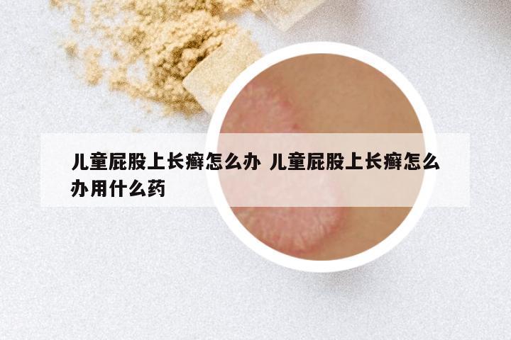 儿童屁股上长癣怎么办 儿童屁股上长癣怎么办用什么药
