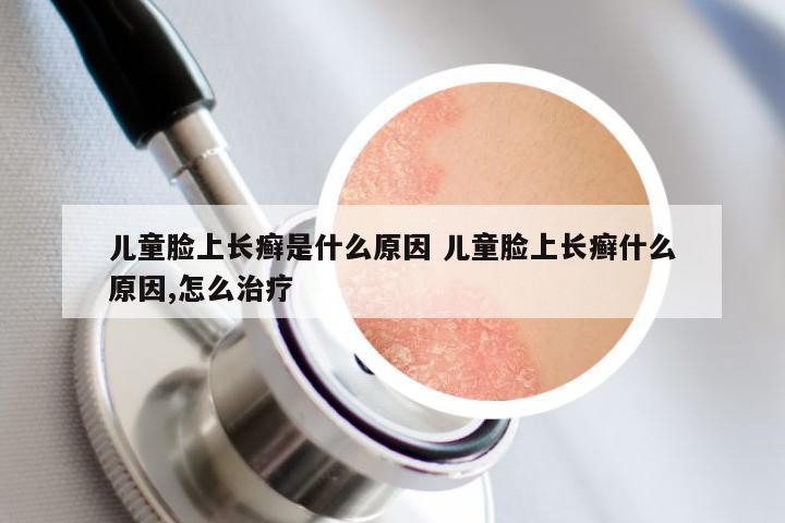 儿童脸上长癣是什么原因 儿童脸上长癣什么原因,怎么治疗