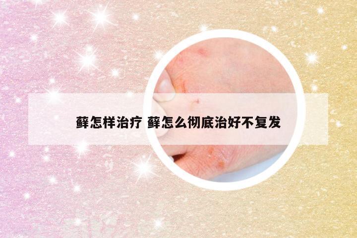 藓怎样治疗 藓怎么彻底治好不复发