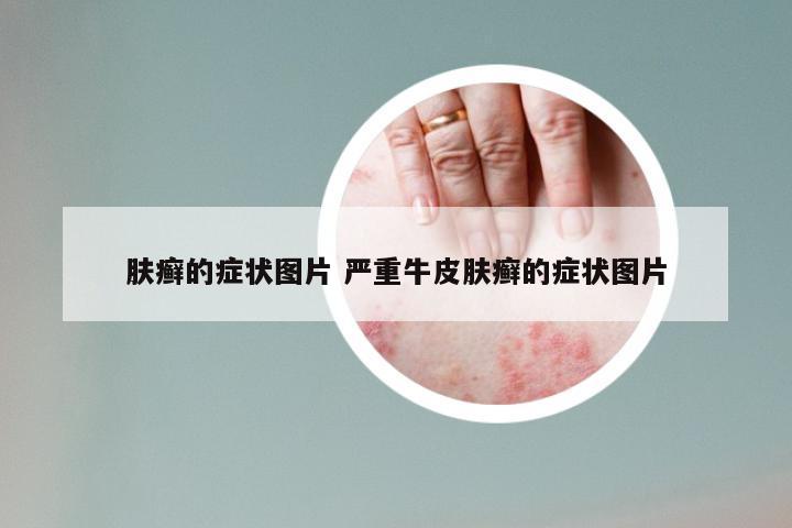 肤癣的症状图片 严重牛皮肤癣的症状图片