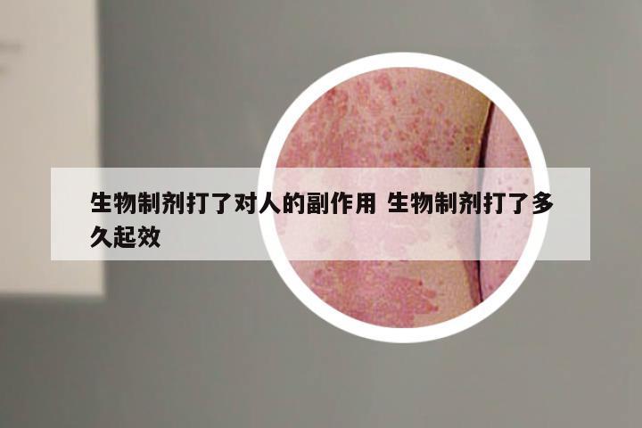生物制剂打了对人的副作用 生物制剂打了多久起效