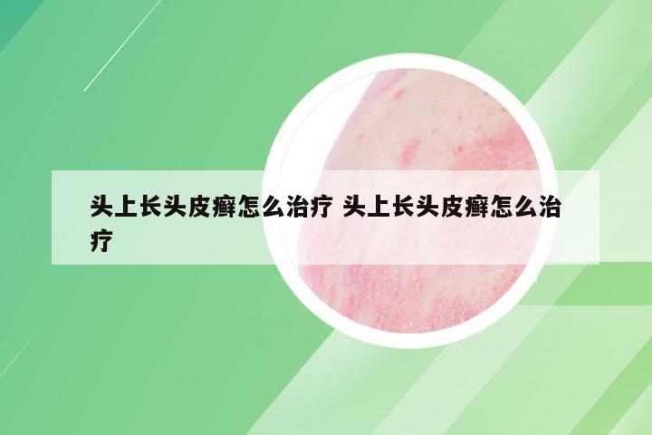 头上长头皮癣怎么治疗 头上长头皮癣怎么治疗